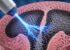 Innowacyjny zabieg raka prostaty metodą IRE (nieodwracalna elektroporacja) z wykorzystaniem AI