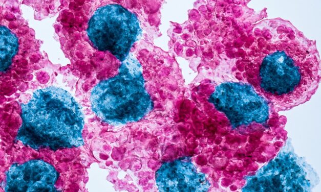 Receptor folianowy alfa (FRα) w&nbsp;raku jajnika. Jak wykonać badanie i&nbsp;dlaczego warto o&nbsp;nie&nbsp;zapytać?
